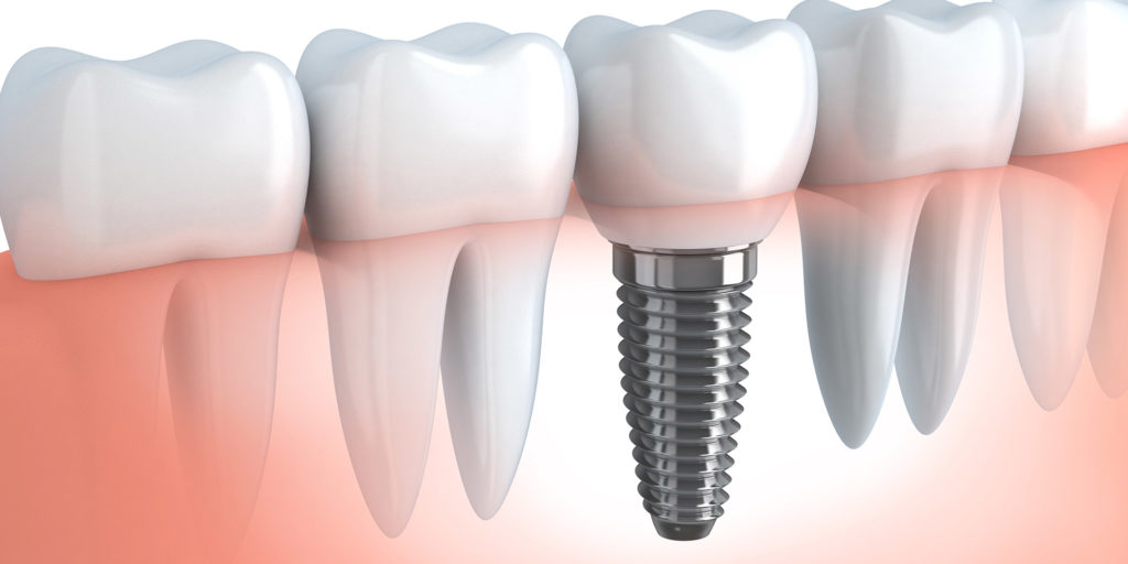 Single Dental Implant In Gumline