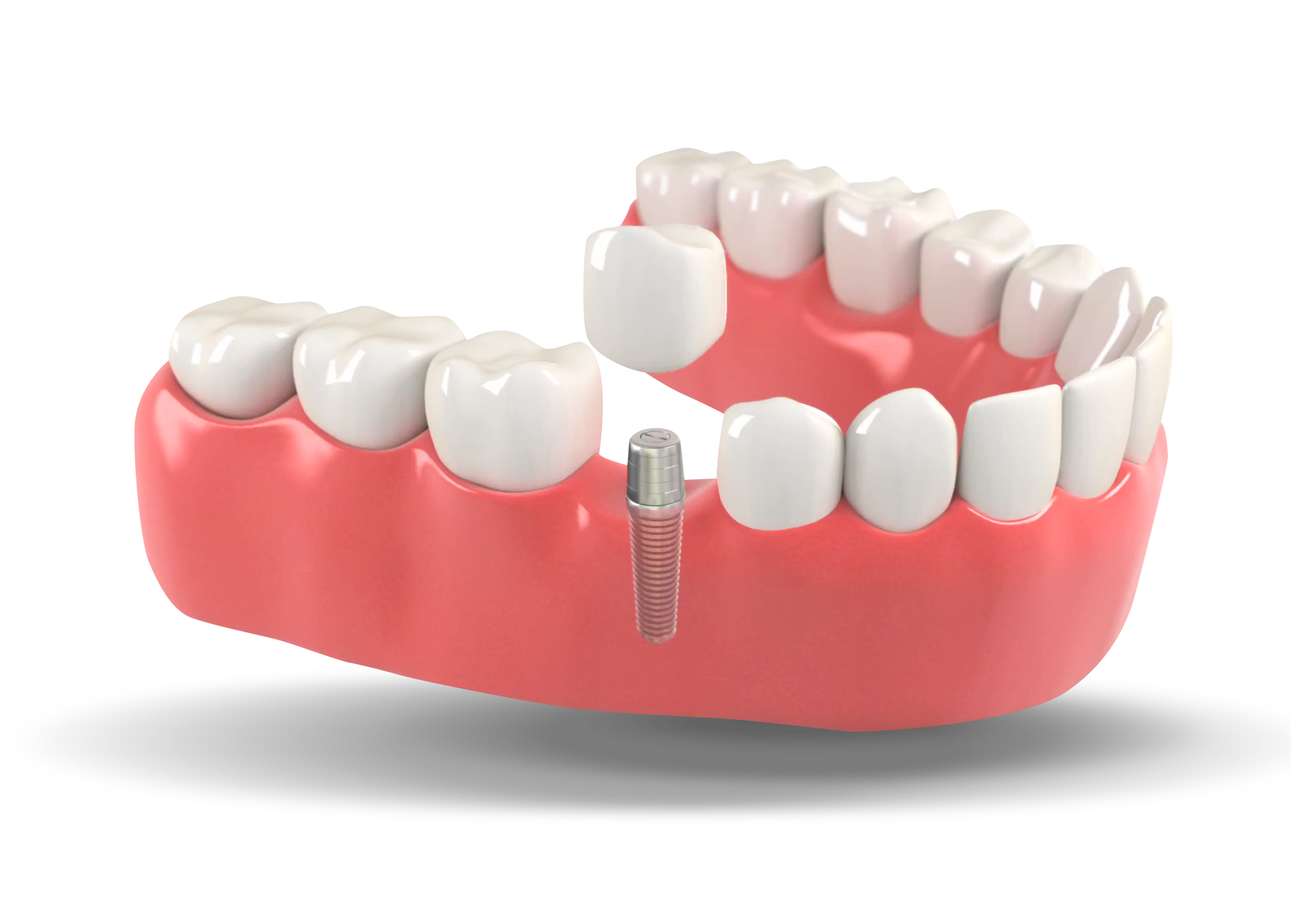 Dental implant