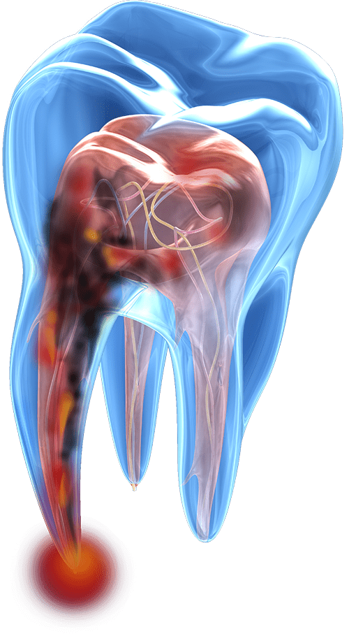 toothache model