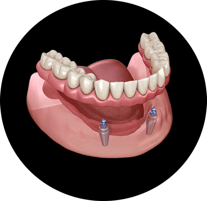 Implant supported dentures