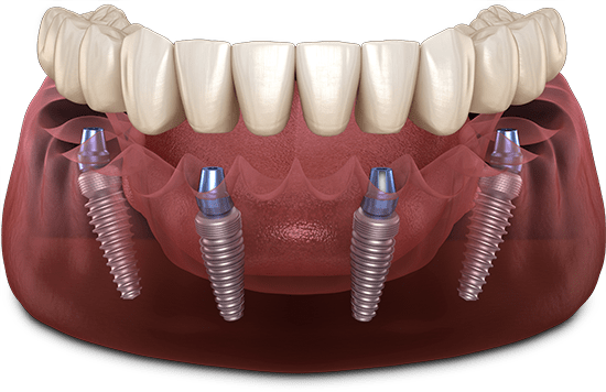 All On 4 Dental Implants