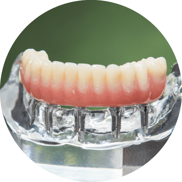 full mouth dental implants model