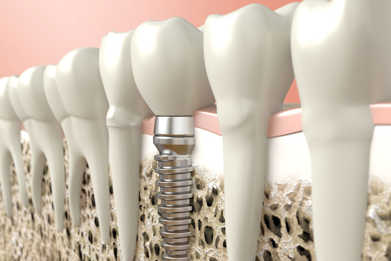 Dental Implant In Bone Surrounded By Natural Teeth