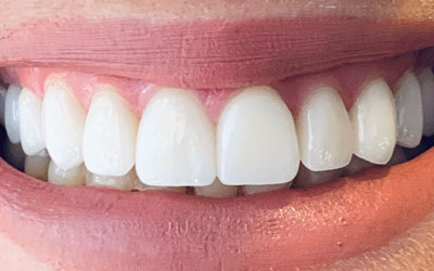 A restored smile showcasing the remarkable recovery from enamel loss, with cavities treated and chipped teeth rebuilt, radiating health and newfound confidence.