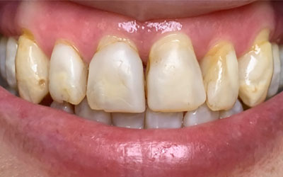 A hesitant smile overshadowed by color inconsistencies and noticeable wear on the teeth, hinting at the need for aesthetic improvement.