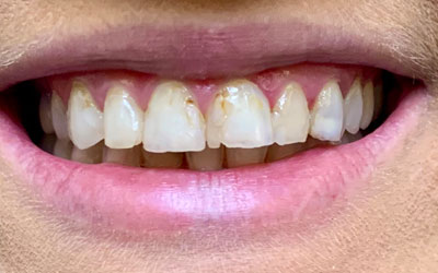 A guarded smile revealing significant enamel loss, leading to cavities and visibly chipped and broken teeth, suggesting urgent dental care is needed.