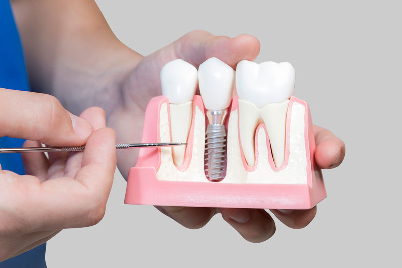 Dental Assistant Showing Off A Dental Implant In A Jawbone Cutaway Model in Charlotte, NC