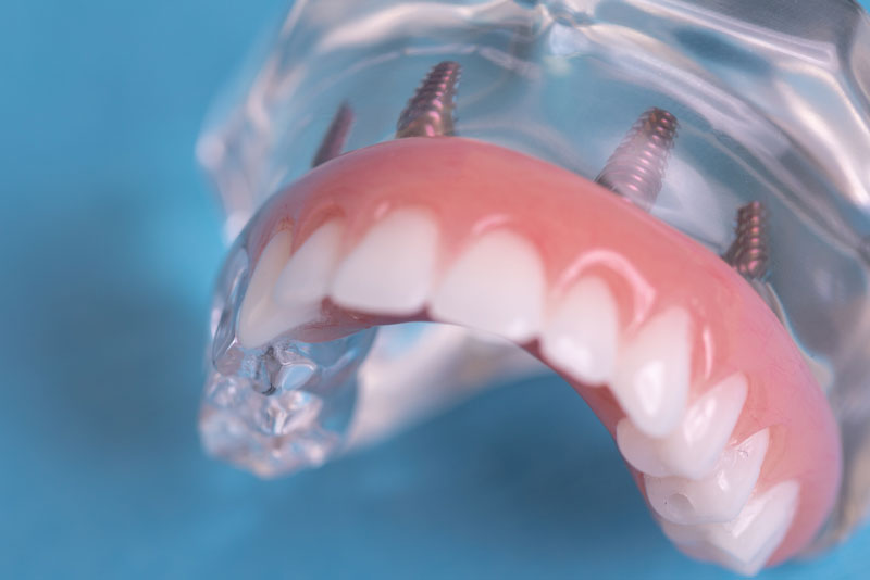 All-On-4 Full Arch Dental Implant Model