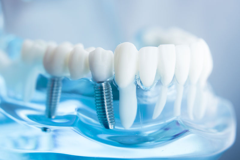 a model of two placed dental implants