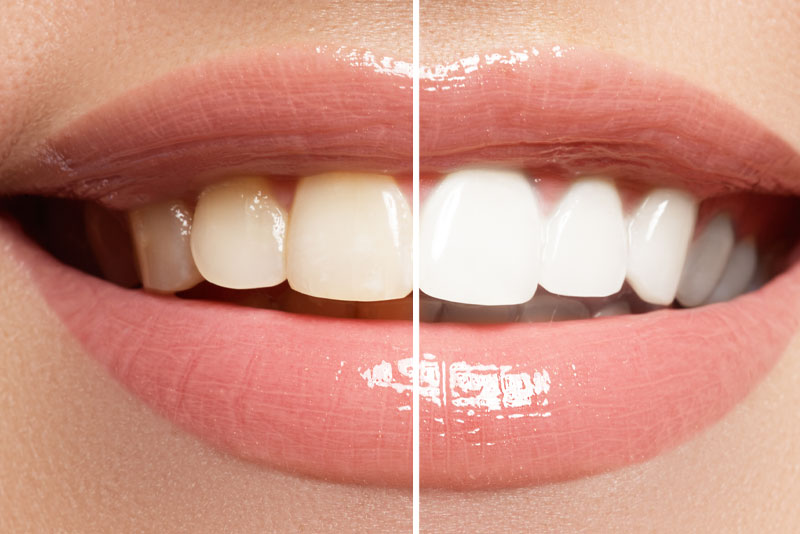 Teeth whitening before and after comparison