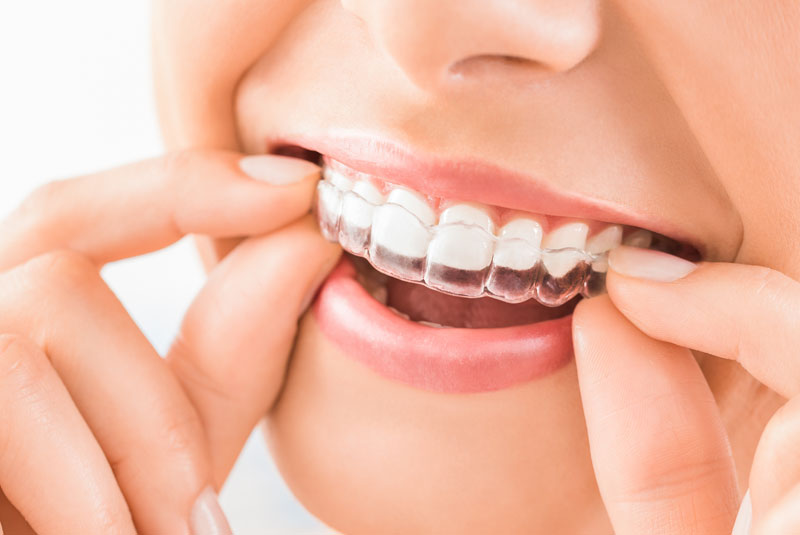 a dental patient happily putting an Invisalign aligner on her teeth for her cosmetic dentistry needs