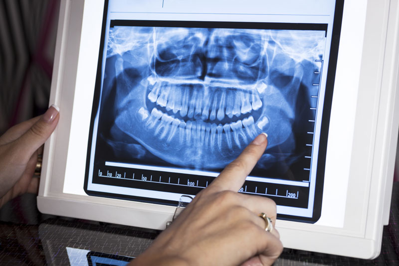 a dental patient xray.