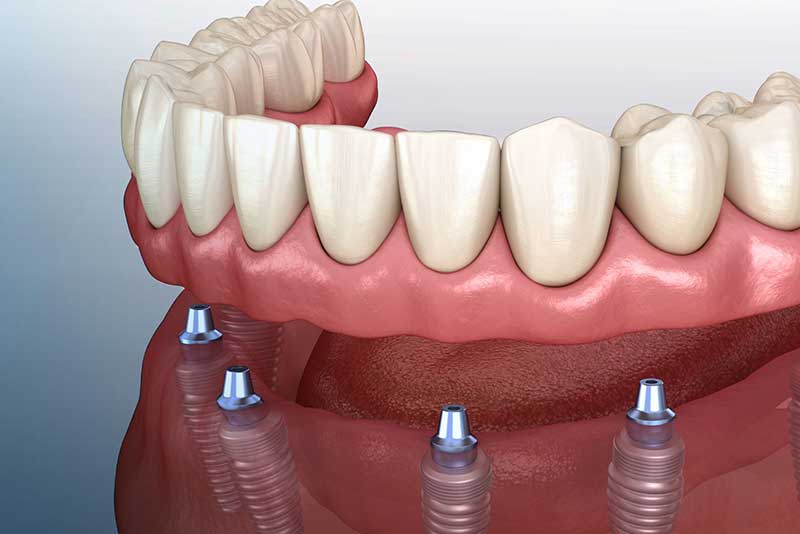 a model of an implant supported denture