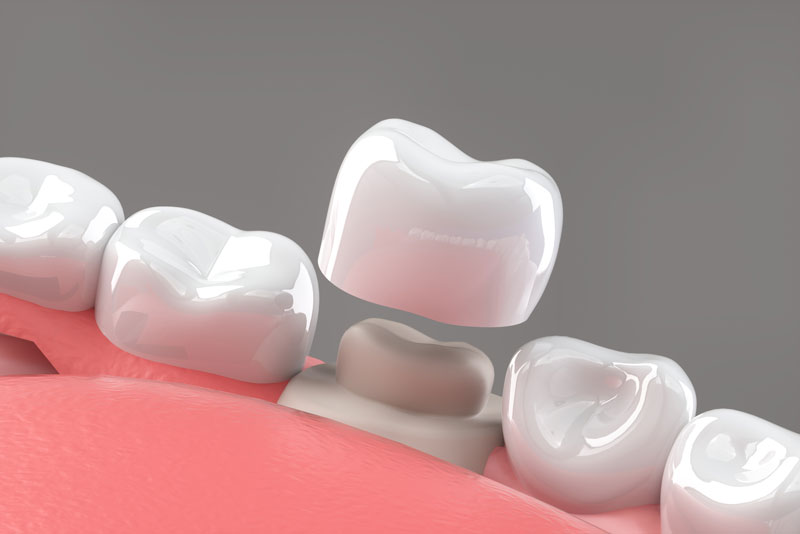 A Dental Crown Model In An Arch Of Teeth