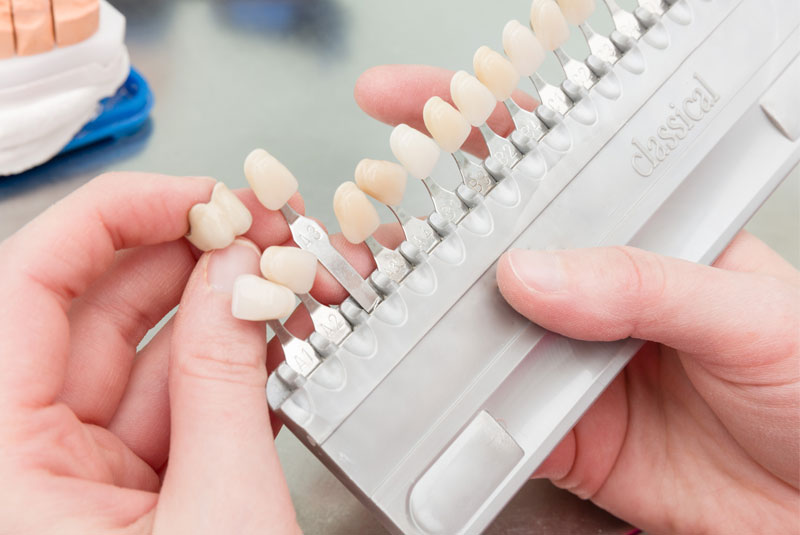 Dental Veneer Tray Being Handled By A Dentist Placing Porcelain Veneers