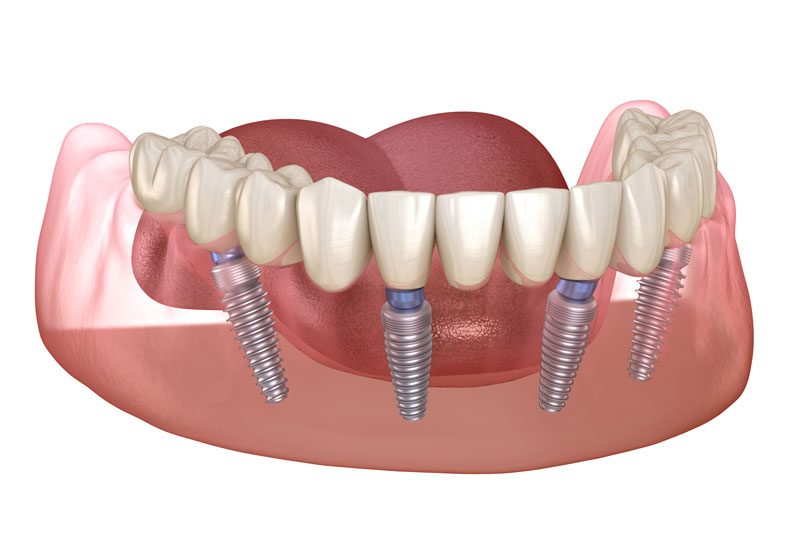 an image of an all-on-4 dental implant model that shows how it can benefit a patients smile with with just four dental implants supporting a prosthesis, which is hovering over the dental implants.
