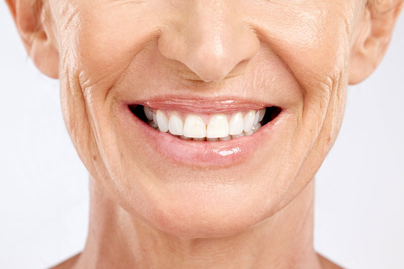 An image of an older woman smiling with porcelain veneers