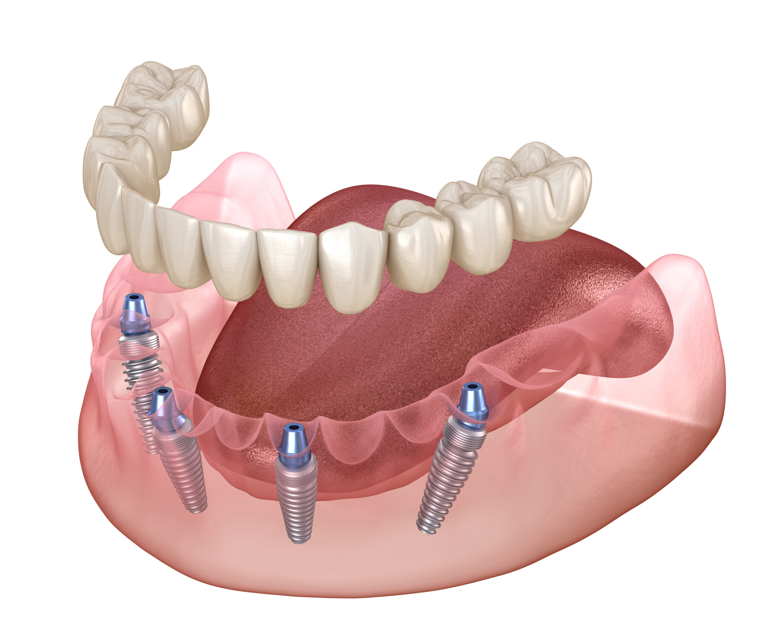 Mandibular prosthesis All on 4 system supported by implants. Medically accurate 3D illustration of human teeth and dentures concept.