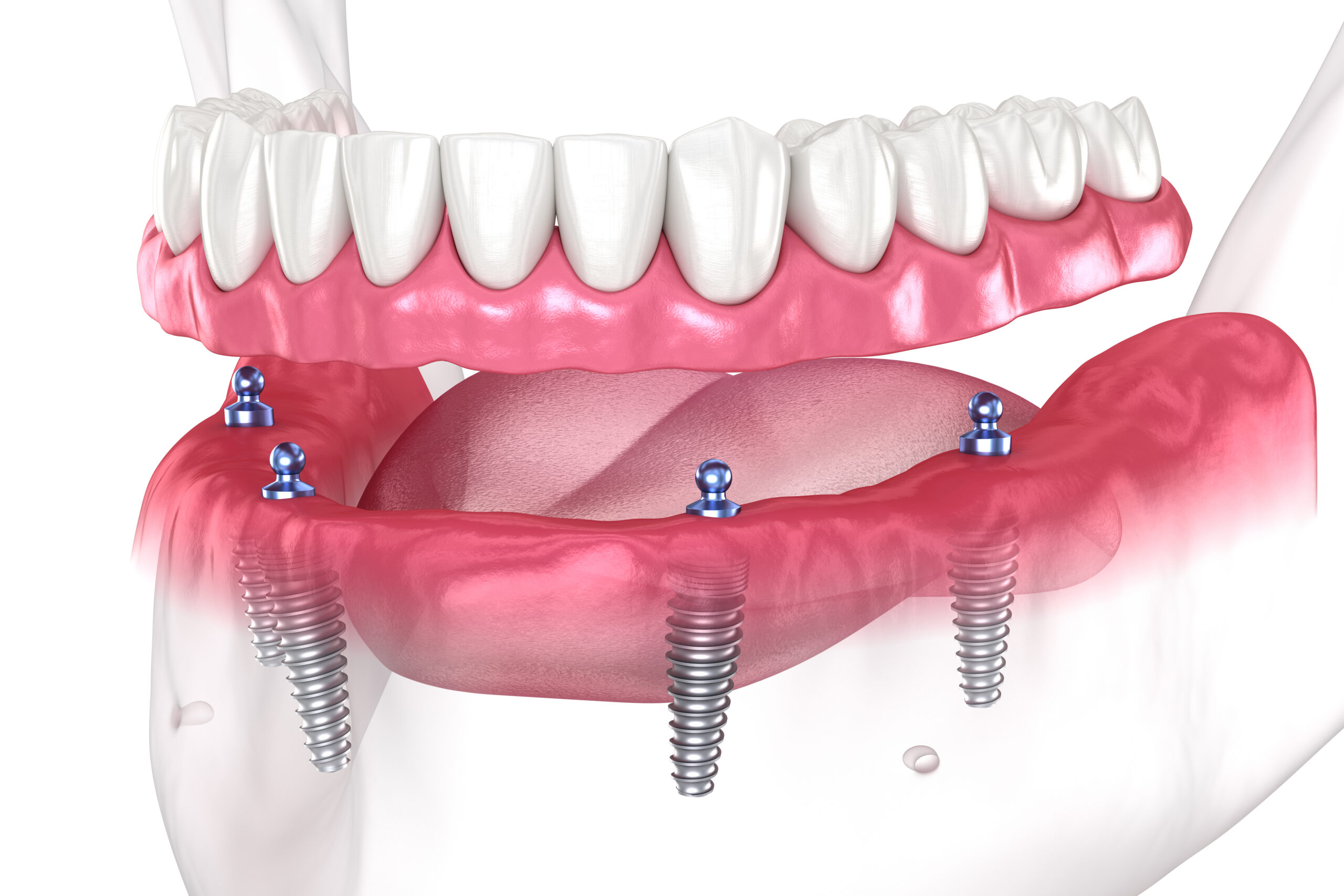 an image of a 3D All-on-Four dental implants model.