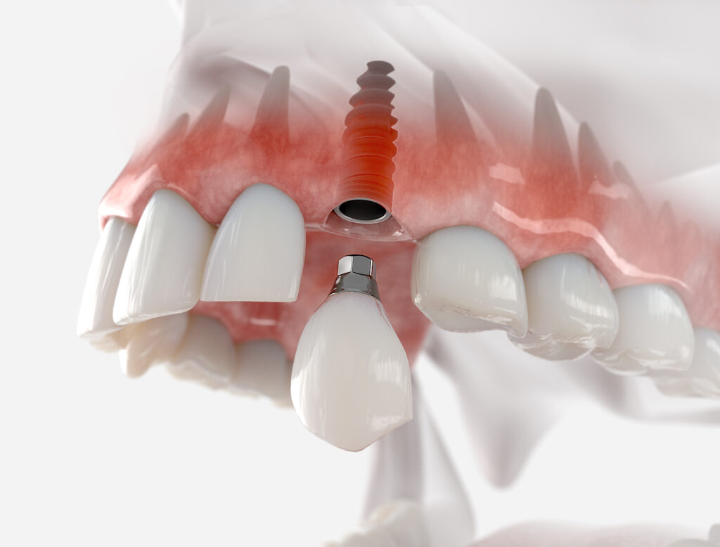 an image of a dental implant.