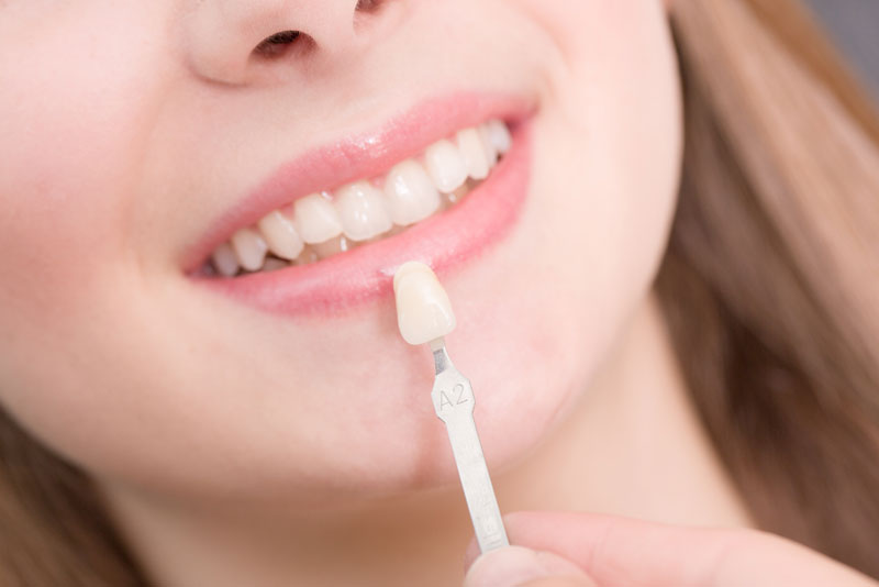 dental veneers patient.