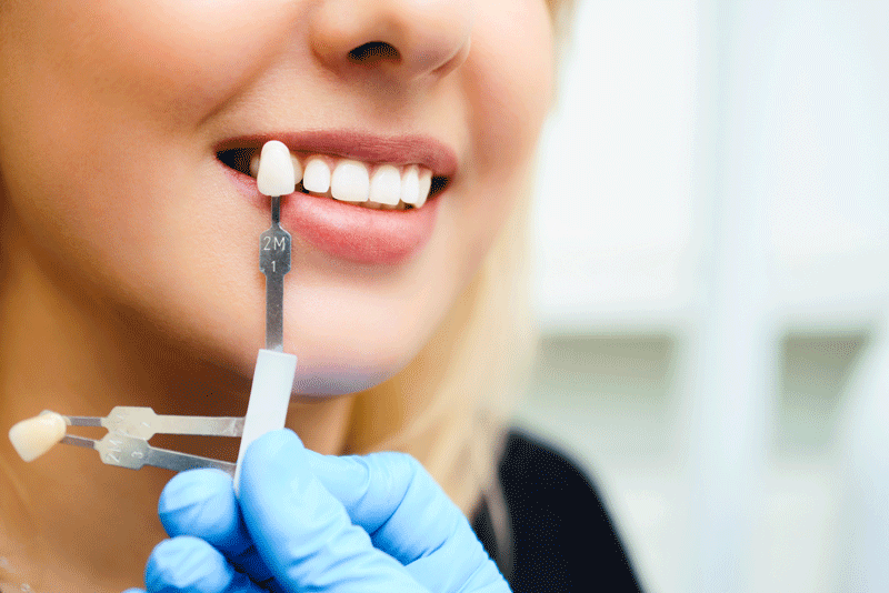 Beautiful smile and white teeth of a young woman. Matching the shades of the implants or the process of teeth whitening.