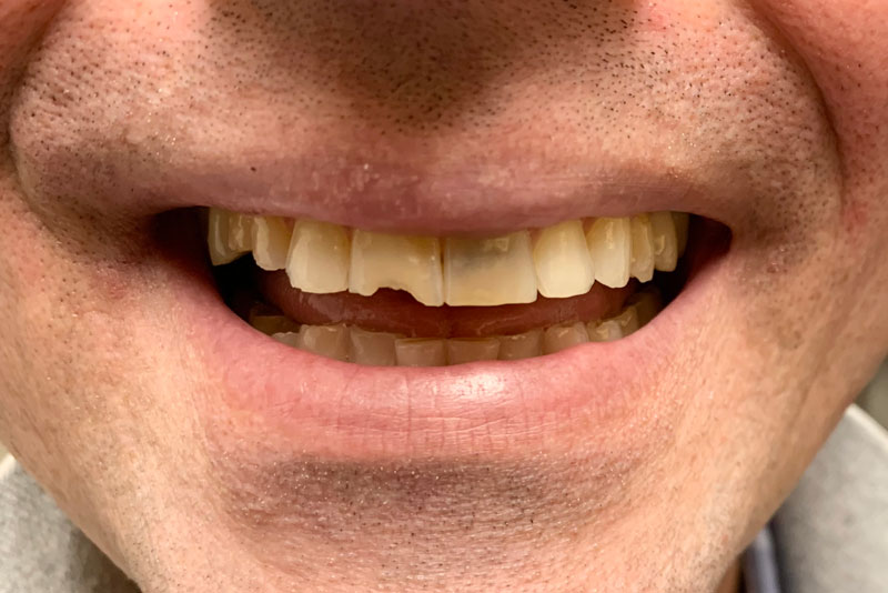 A smile with chipped front teeth and noticeable yellow tint from staining.