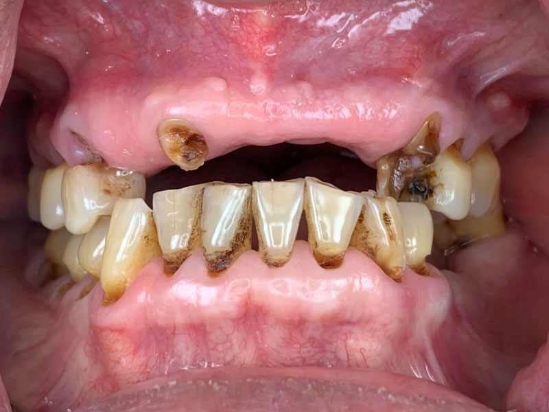 Pyong Missing Front Teeth, Deteriorated Bottom Teeth