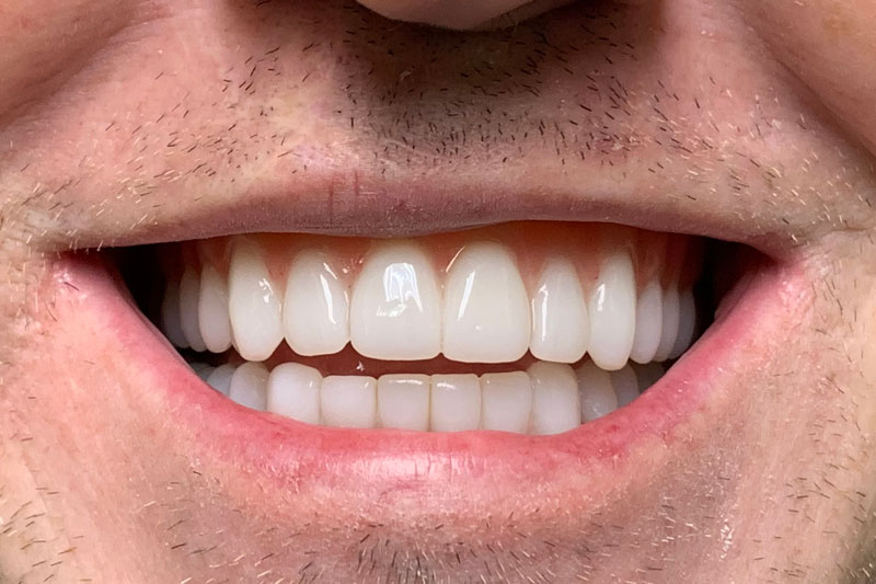 A liberated smile boasting implant-based dentures that mimic a natural look, combining aesthetic appeal with the joy of regained functionality.
