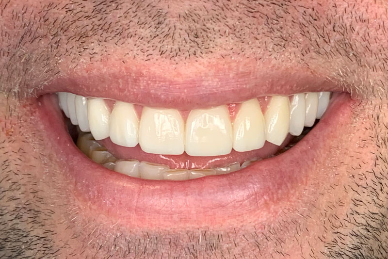 Restored teeth with composite bonding for a smooth appearance and a bright, whitened smile.