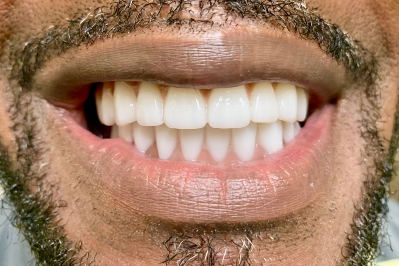 A transformative smile graced with full-arch implants, offering a seamless, natural-looking set of teeth and restoring the full radiance and function of a natural smile.