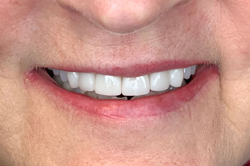 Straightened teeth and a lifted, white smile free of discoloration.