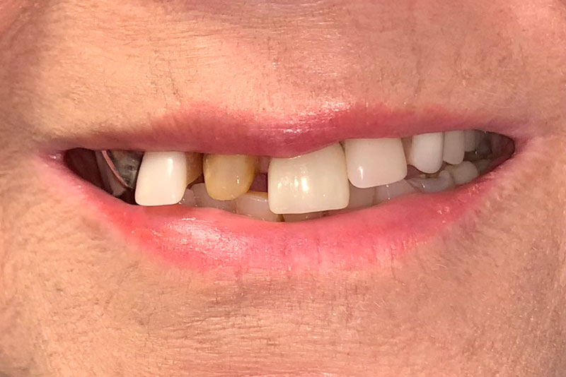 A smile with crooked teeth and an overbite, creating an uneven appearance.