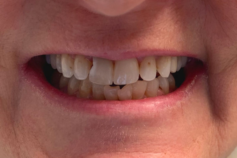 A smile showing crooked alignment and a yellow hue from staining.