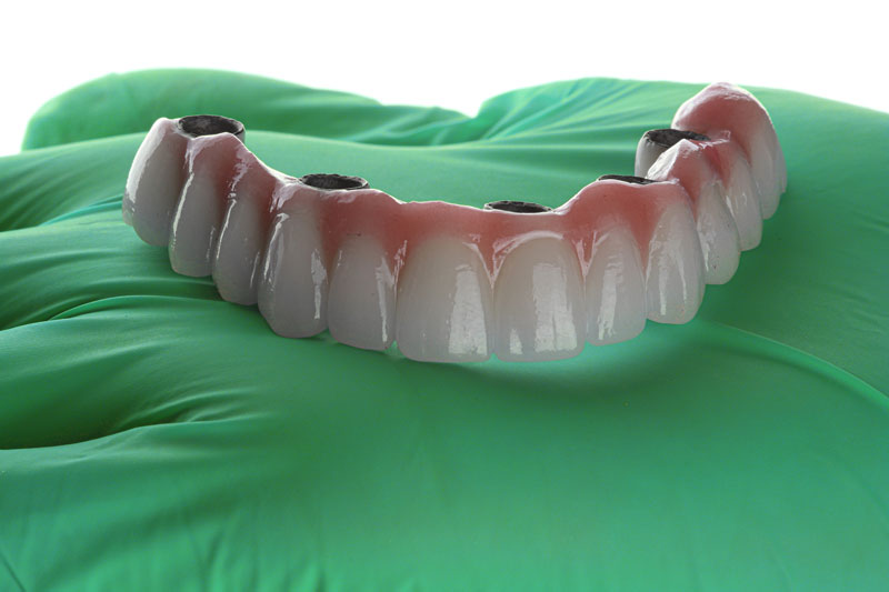 a full arch of teeth waiting to be placed onto the jaw with 4 implant holes