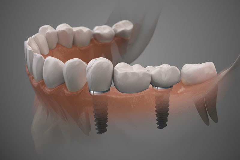2 single dental implants with a crown on top of it