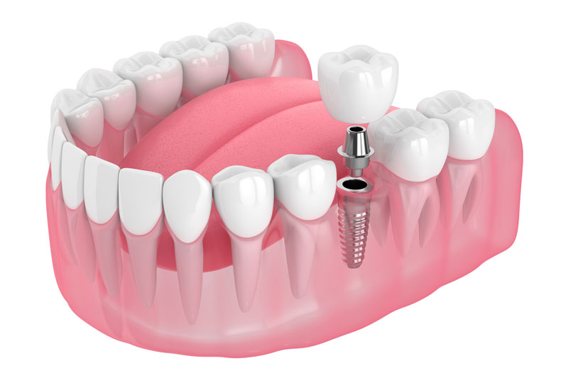 a single dental implant with the crown and abutment floating over the implant