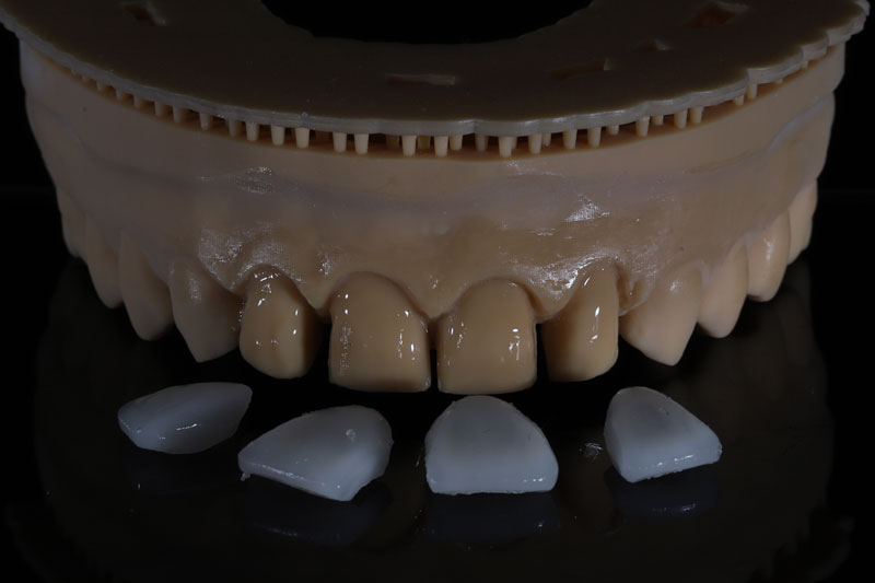 4 Veneer Shells placed infront of a model ready to be put on