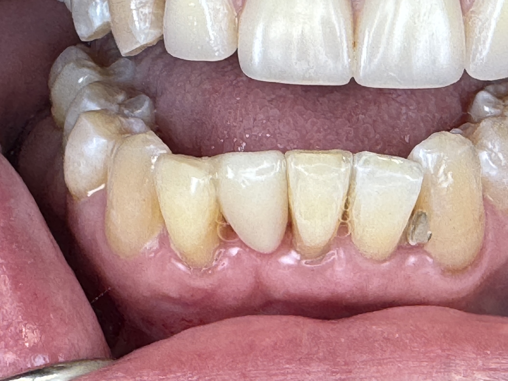 a patient that got a bridge restored with CEREC same day crowns