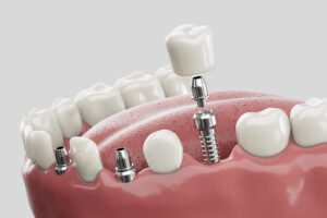3 single dental implants with a crown on top of the implant