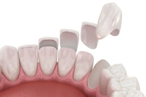 porcelain veneers being placed onto the teeth of a 3d model