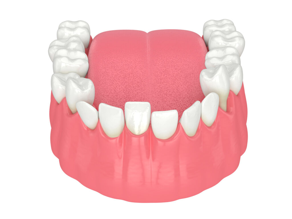 3d render of jaw with abnormal teeth position