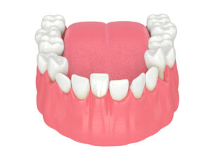 3d render of jaw with abnormal teeth position