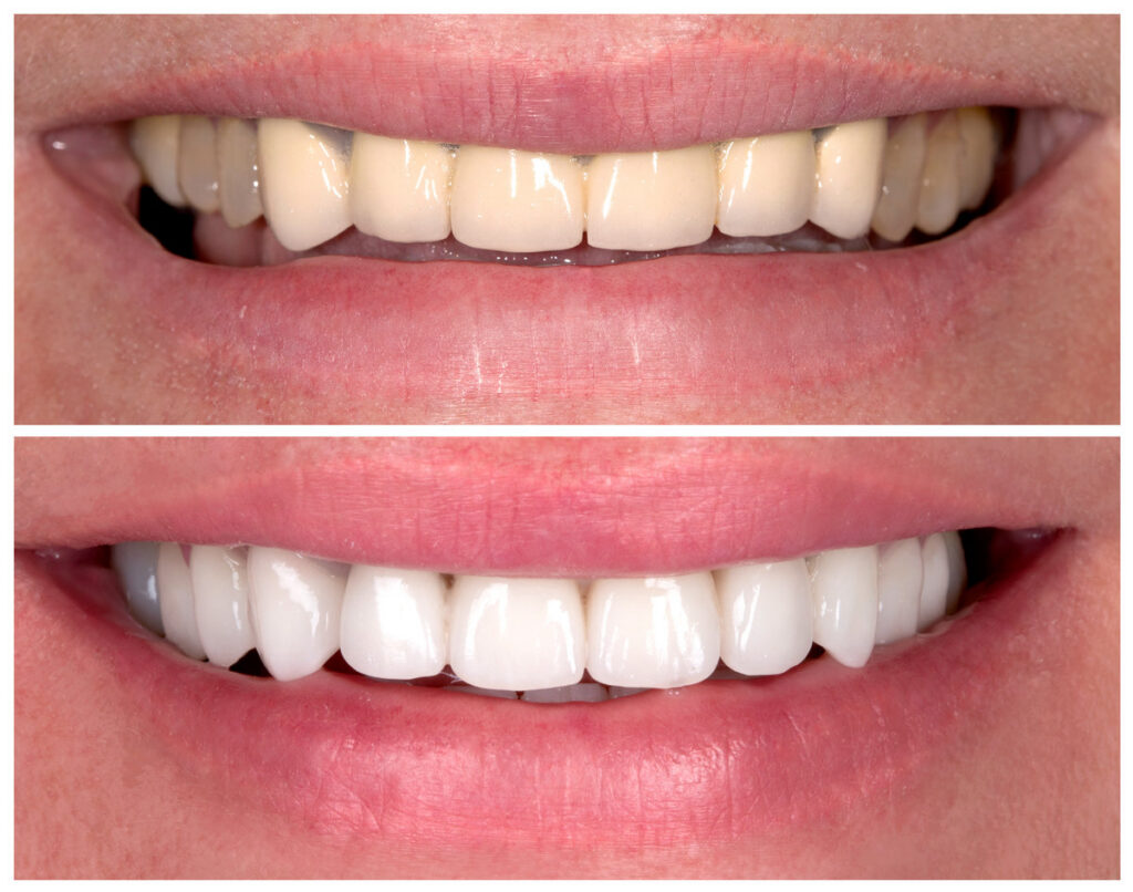 Perfect smile before and after bleaching procedure whitening of zircon arch ceramic prothesis Implants crowns. Dental restoration treatment clinic patient. Result of oral surgery dentistry