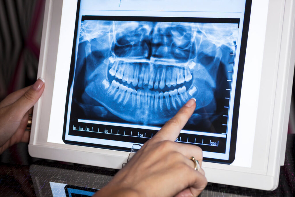 DEntal panoramic x-ray in wiever with finger pointing