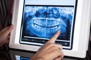 DEntal panoramic x-ray in wiever with finger pointing