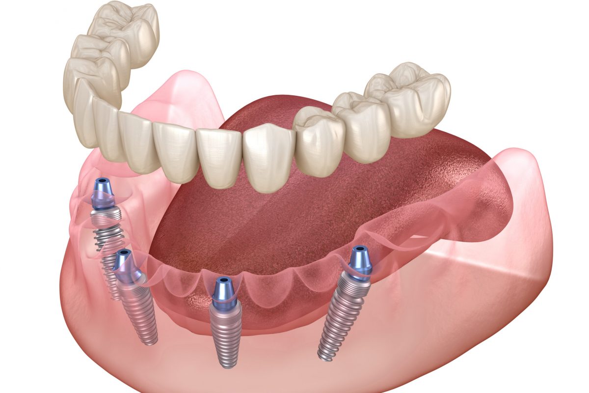Mandibular prosthesis All on 4 system supported by implants. Medically accurate 3D illustration of human teeth and dentures concept.