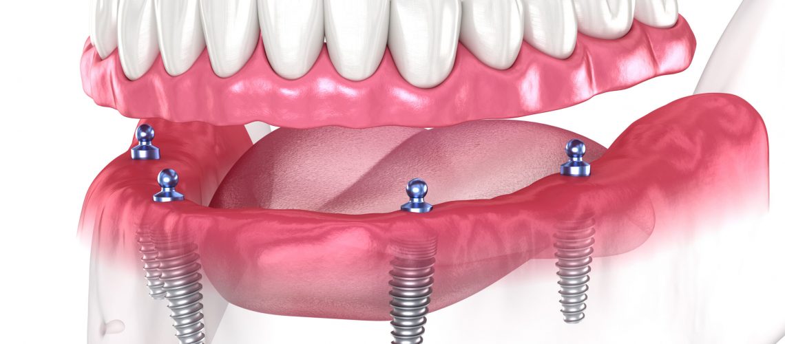 an image of a 3D All-on-Four dental implants model.