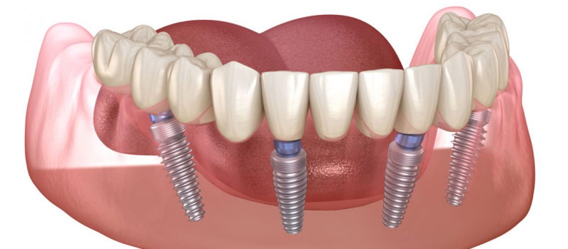an image of an all-on-4 dental implant model that shows how the dental implants and prosthetic are placed in the way the dental implant posts are angled towards the jawbone and the prosthetic is hovering over the dental implant posts.