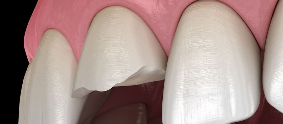 Chipped Tooth Graphic